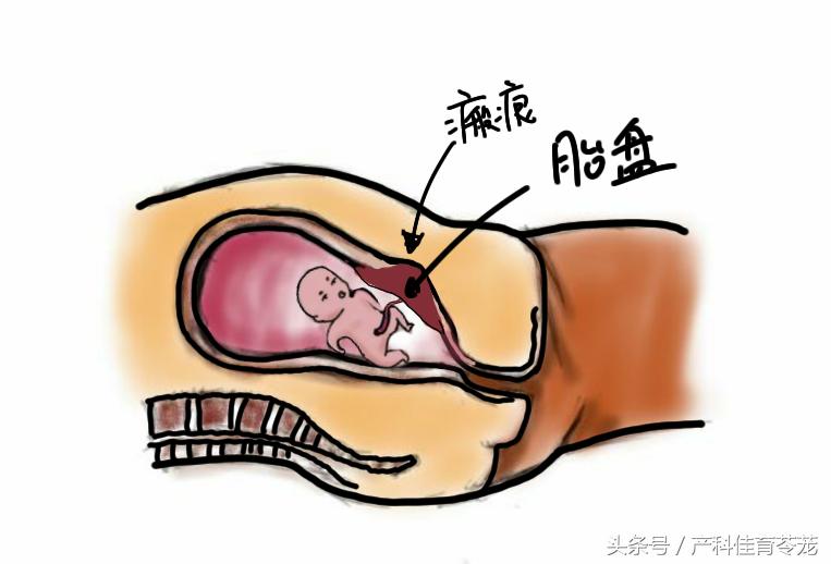 胚胎没有长在瘢痕处会子宫破裂吗,胚胎长在疤痕上怎么办