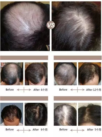 头顶头发稀疏毛囊是否坏死,因为脱发怎么知道毛囊有没有坏死