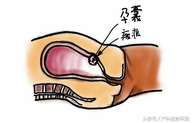 胚胎没有长在瘢痕处会子宫破裂吗,胚胎长在疤痕上怎么办