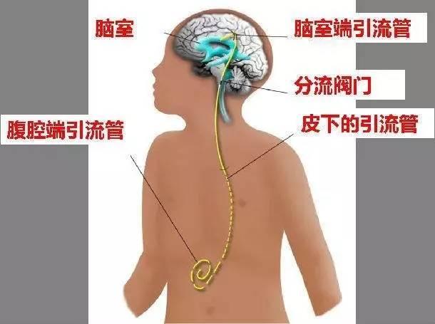 脑积水如何选择治疗方式,脑积水治疗方案哪种最好