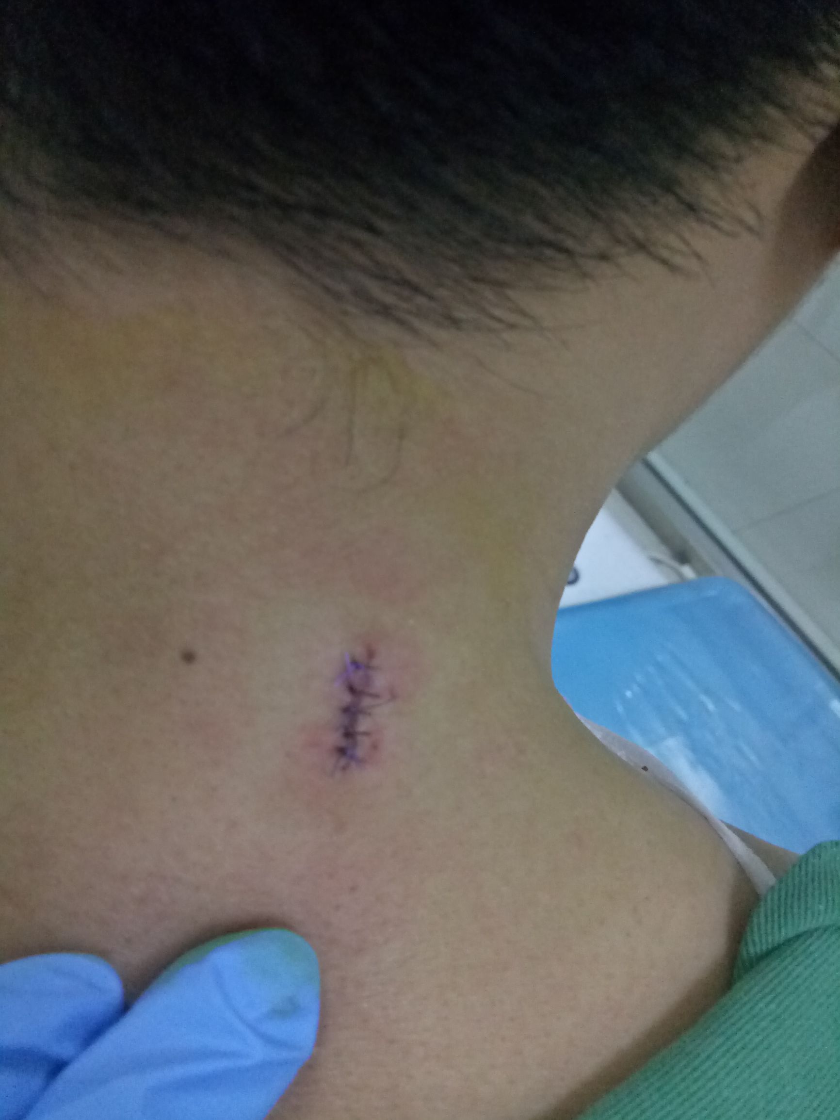 肩上的痣有危险吗,脖子后面有痣会压财吗