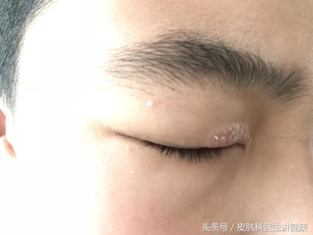 甲硝唑引起的药物过敏，模仿起了神经性皮炎