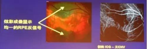 COFDS2016KarlG.Csaky：视网膜色素上皮脱离在干性AMD进展中的影响