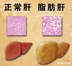 转氨酶高血脂高要关注什么,转氨酶高关注吃什么食物好