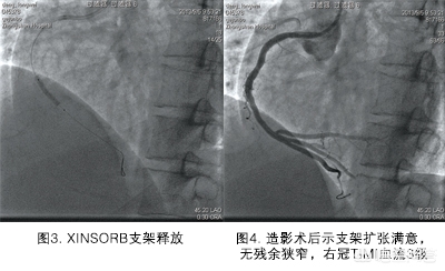 生物可降解支架治疗冠心病好吗,冠心病传统支架和可降解支架