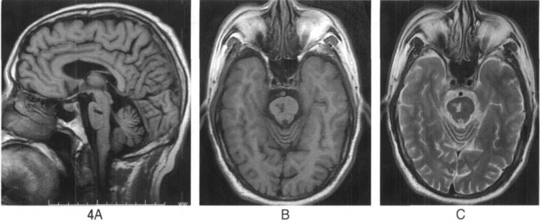 血管周围间隙的核磁影像学表现,颅脑血管间隙mri图像