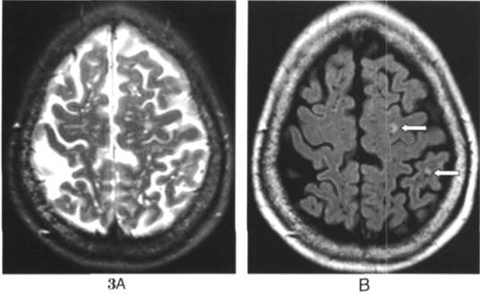 血管周围间隙的核磁影像学表现,颅脑血管间隙mri图像