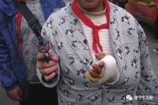 小孩玩打火机被烧成重伤,玩打火机被火烧伤遭毁容的小孩