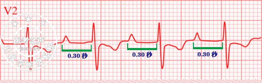 心电图秒懂,心电图零基础都秒懂