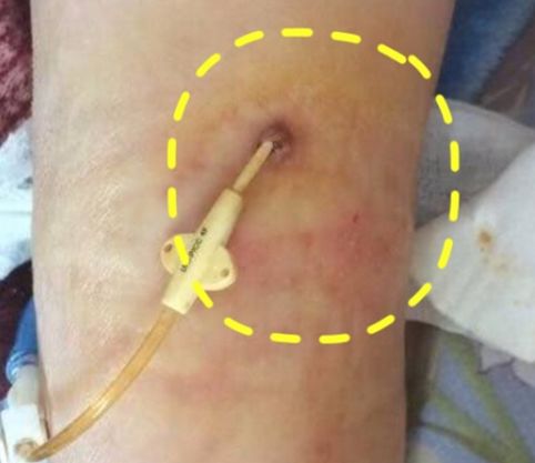 穿刺点感染怎么办？两种方法任你选