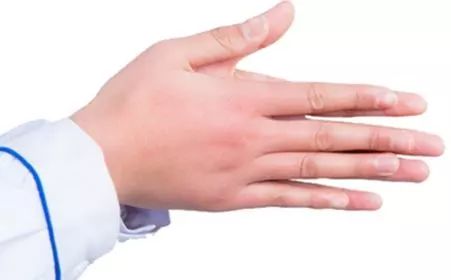 严重冻疮的快速消除方法,冻疮怎么预防护理