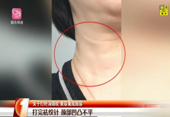 川字纹打除皱针深圳,女子打除皱针整容