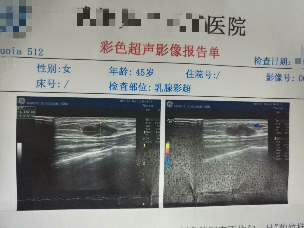 好险！谁说小乳房患癌易发现？这里有一个差点漏诊的病例