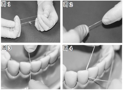 牙上有斑怎么去除,牙斑怎么去除最有效的方法