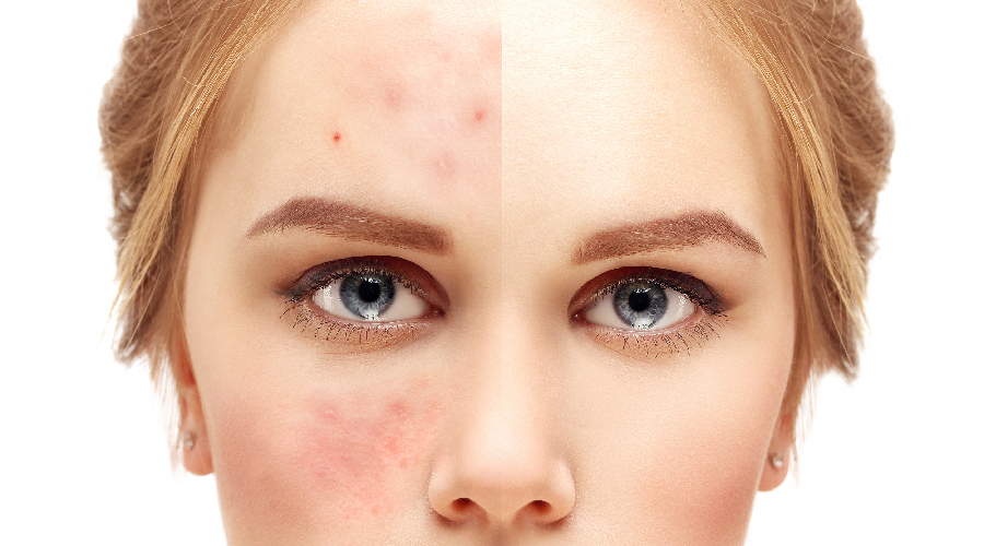 手把手教你正确挤痘不留坑,挤痘挤了个坑