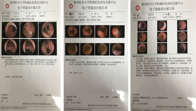 内镜诊疗,内镜小肠手术