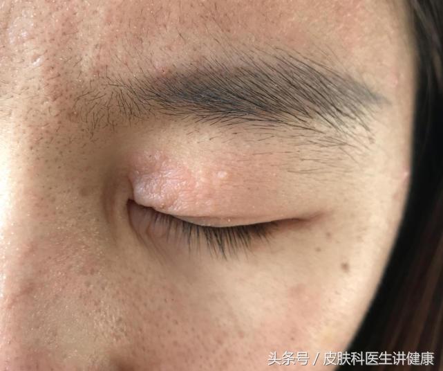 甲硝唑引起的药物过敏，模仿起了神经性皮炎