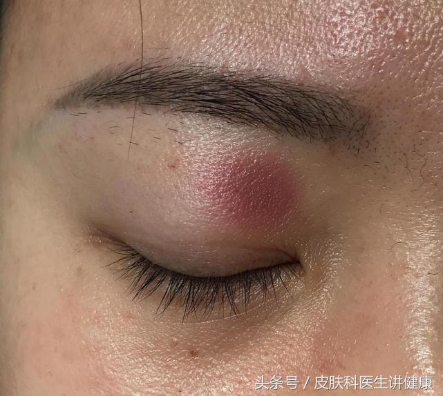 甲硝唑引起的药物过敏，模仿起了神经性皮炎