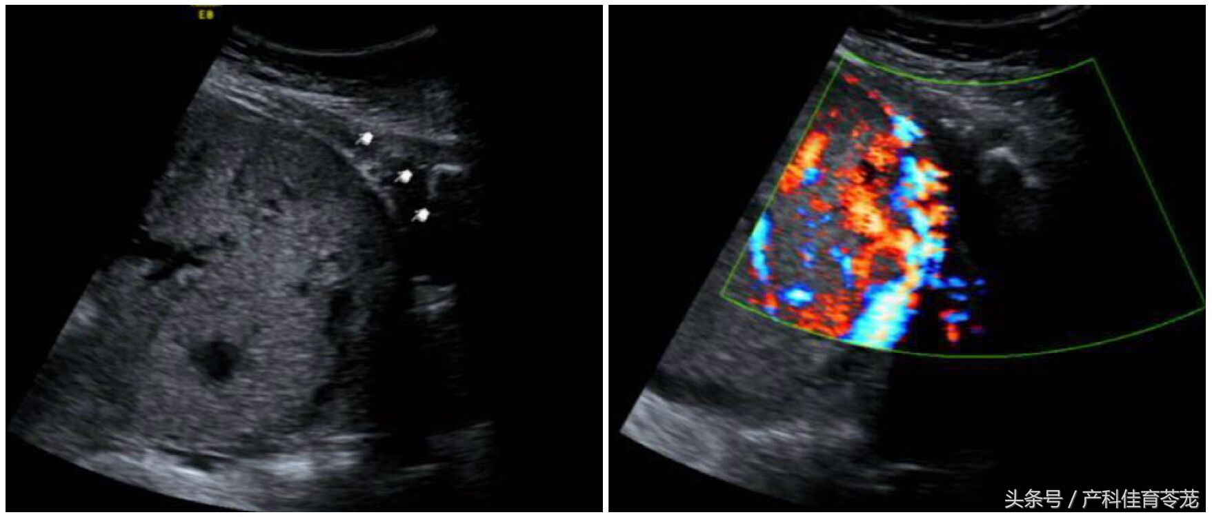 胚胎没有长在瘢痕处会子宫破裂吗,胚胎长在疤痕上怎么办