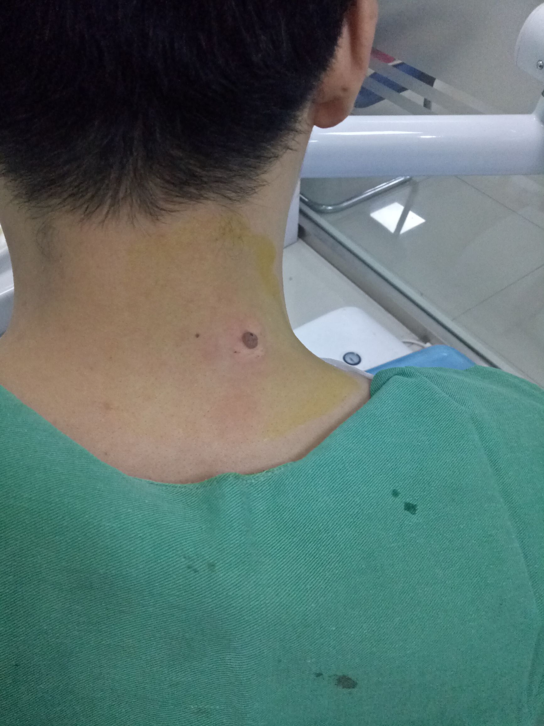 肩上的痣有危险吗,脖子后面有痣会压财吗