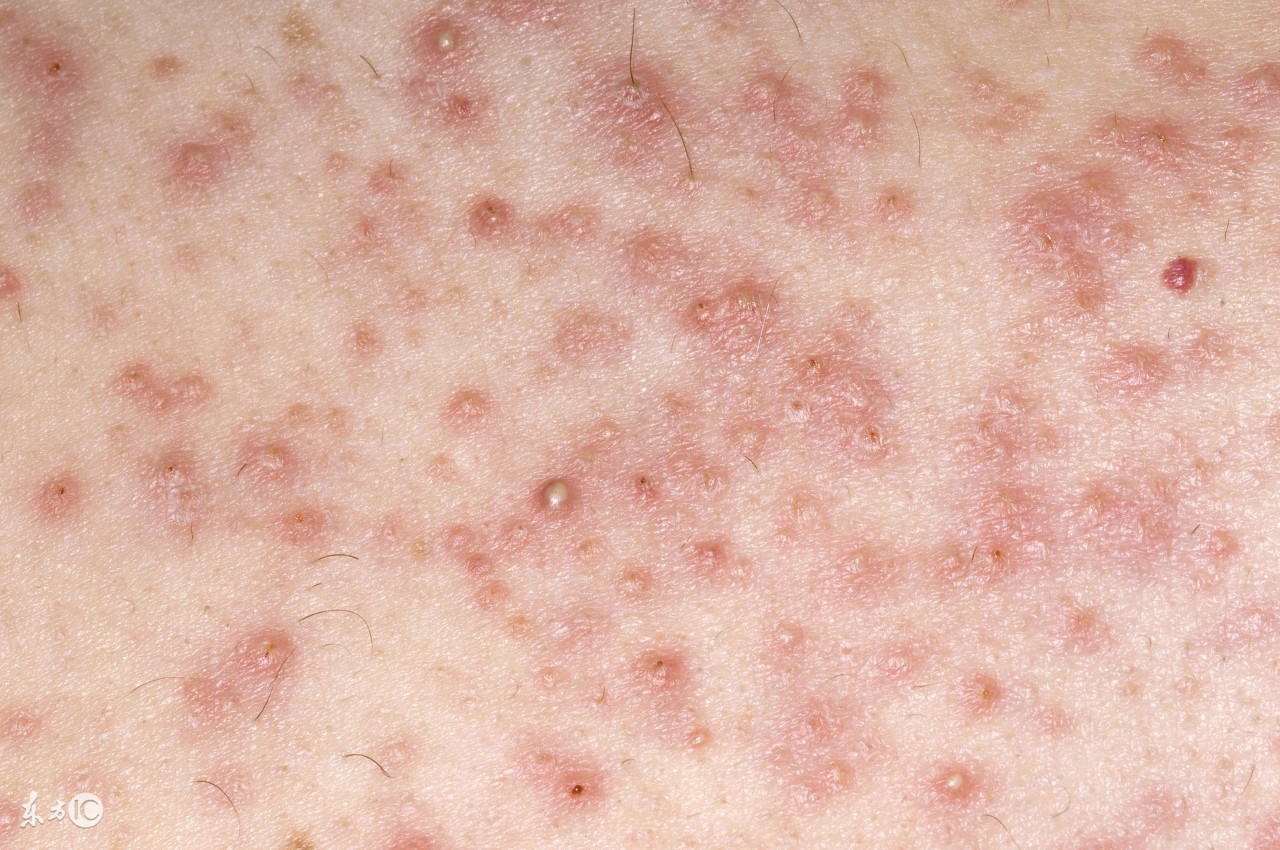 穿凿性毛囊炎最新治疗方法,头上毛囊炎治疗最快方法白醋