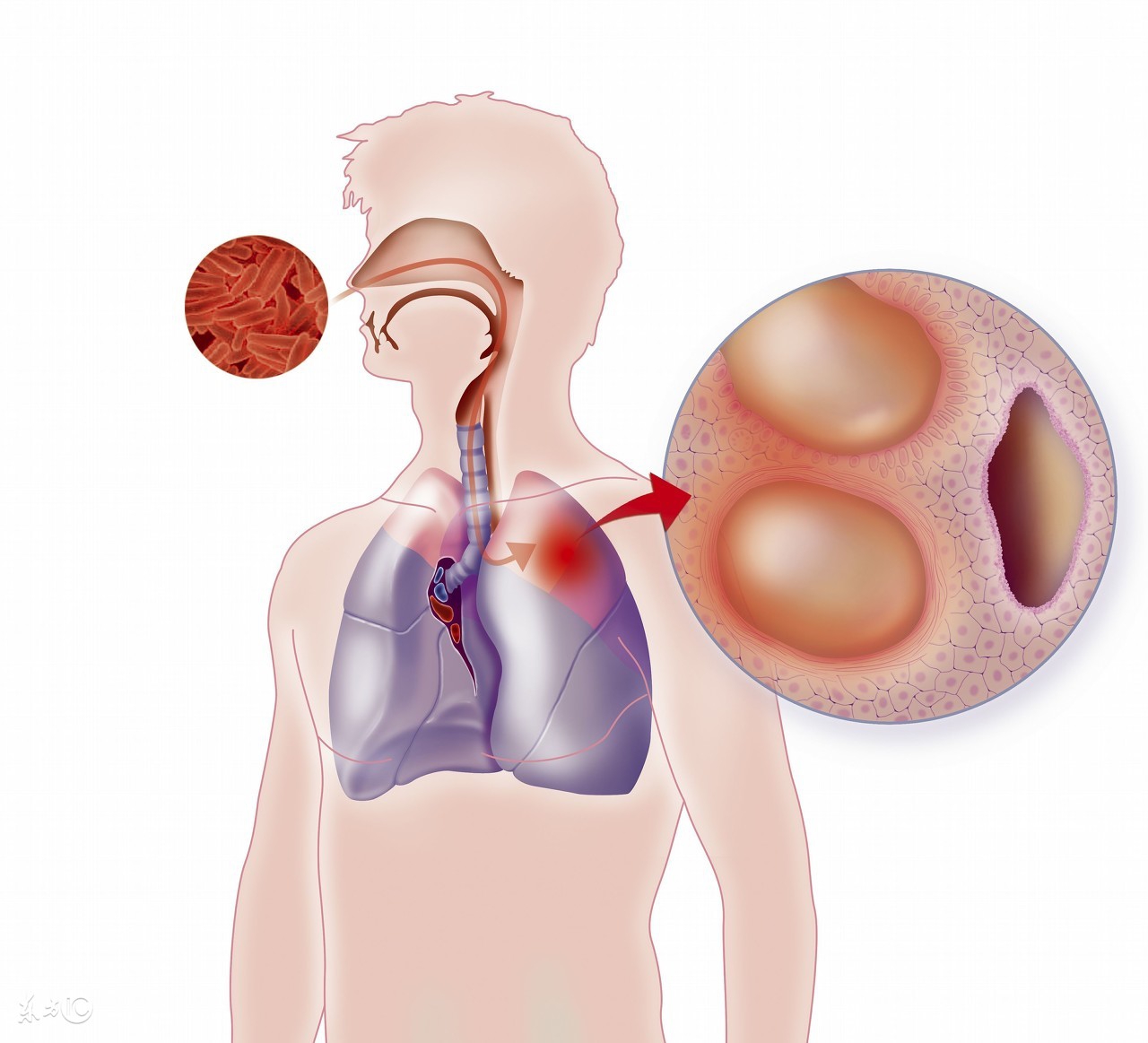 治疗肺结核过程中要关注什么,肺结核在治疗中又严重了怎么回事