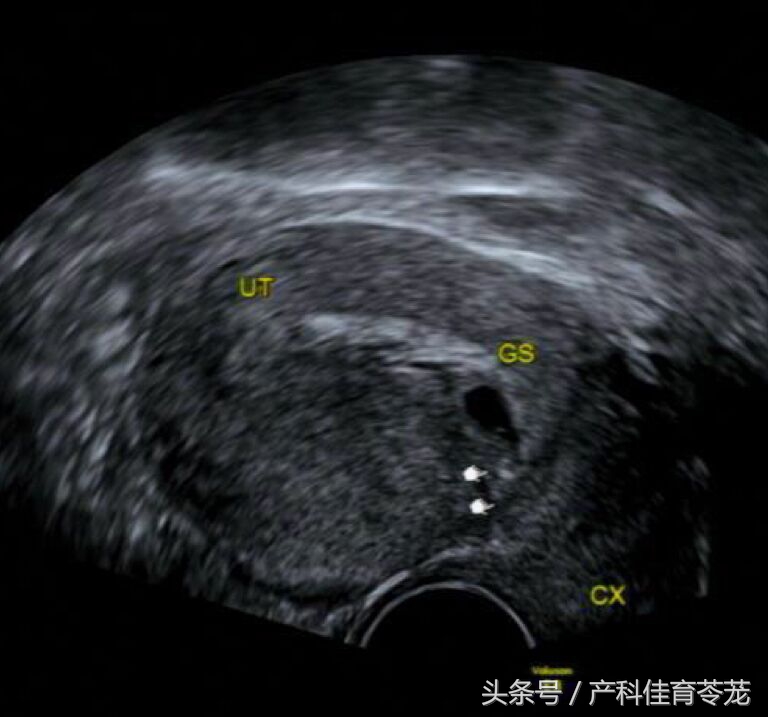 胚胎没有长在瘢痕处会子宫破裂吗,胚胎长在疤痕上怎么办