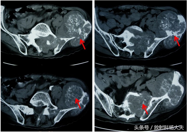 这个15年前就发现的腰部小鹌鹑蛋，让80岁老先生吃了苦头