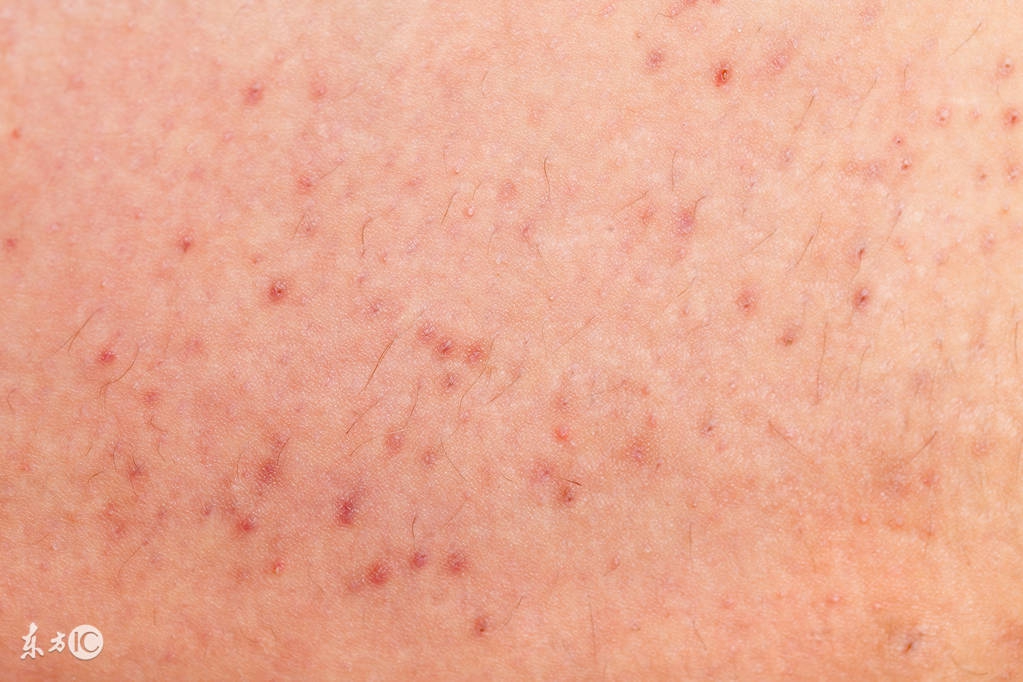 穿凿性毛囊炎最新治疗方法,头上毛囊炎治疗最快方法白醋