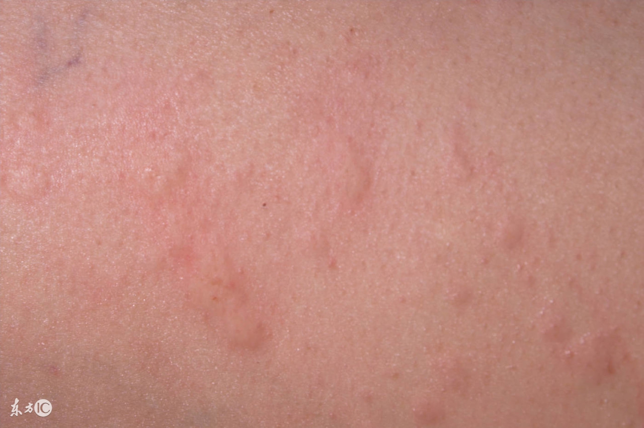 丘疹性荨麻疹的症状有什么,丘疹性荨麻疹有什么症状和感觉