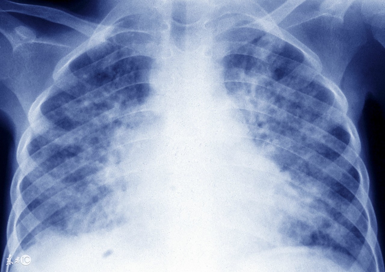 治疗肺结核过程中要关注什么,肺结核在治疗中又严重了怎么回事