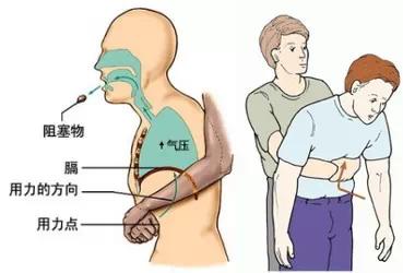 海姆立克自救方法妈妈,海姆立克急救法儿童救妈妈