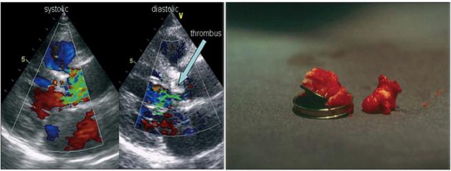 心脏瓣膜置换机械瓣膜后能怀孕吗,心脏瓣膜置换术并发症