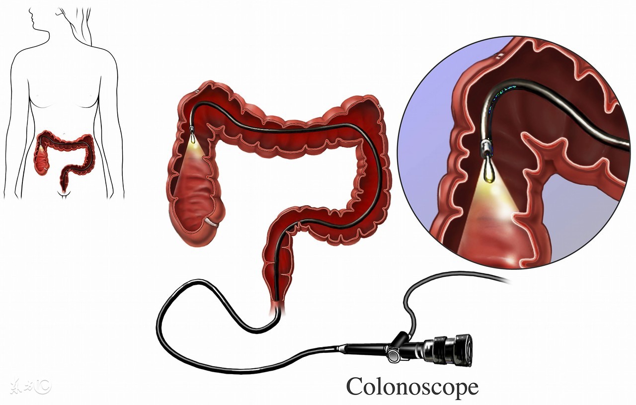 结肠溃疡会导致肠子肿起来吗,结肠是什么原因造成的