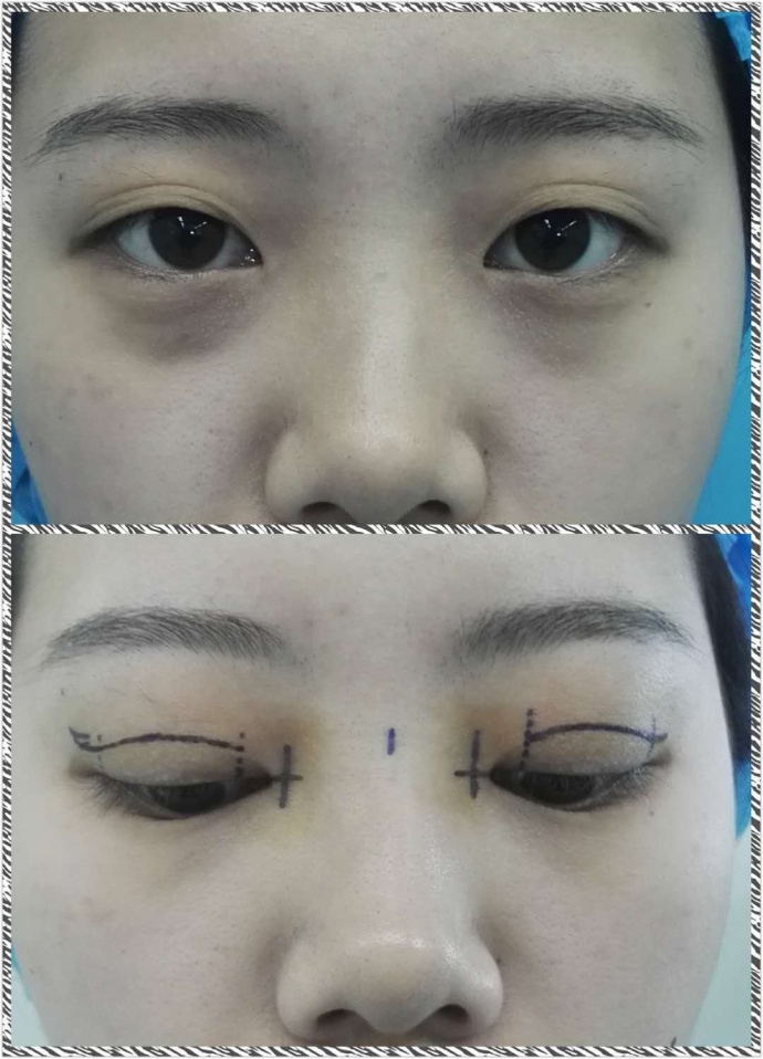 做过埋线还能做双眼皮切开手术吗,陈小剑做双眼皮案例