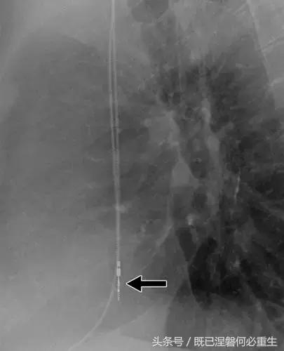 心内除颤仪和起搏器有什么区别,起搏器除颤仪