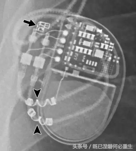 心内除颤仪和起搏器有什么区别,起搏器除颤仪