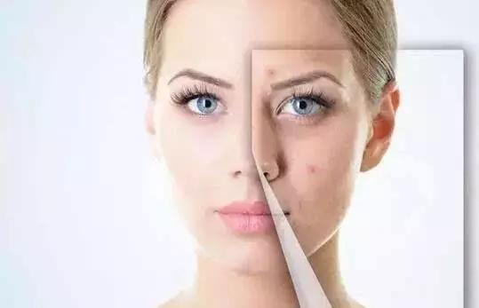 痘印去不掉？看完这篇价值一万块的痘印自救指南，你就会找到答案