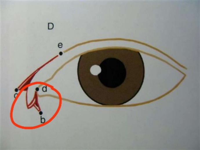 做过埋线还能做双眼皮切开手术吗,陈小剑做双眼皮案例