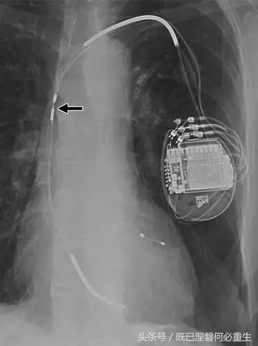 心内除颤仪和起搏器有什么区别,起搏器除颤仪