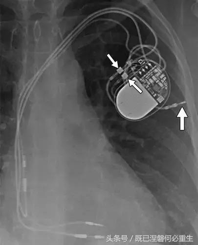 心内除颤仪和起搏器有什么区别,起搏器除颤仪