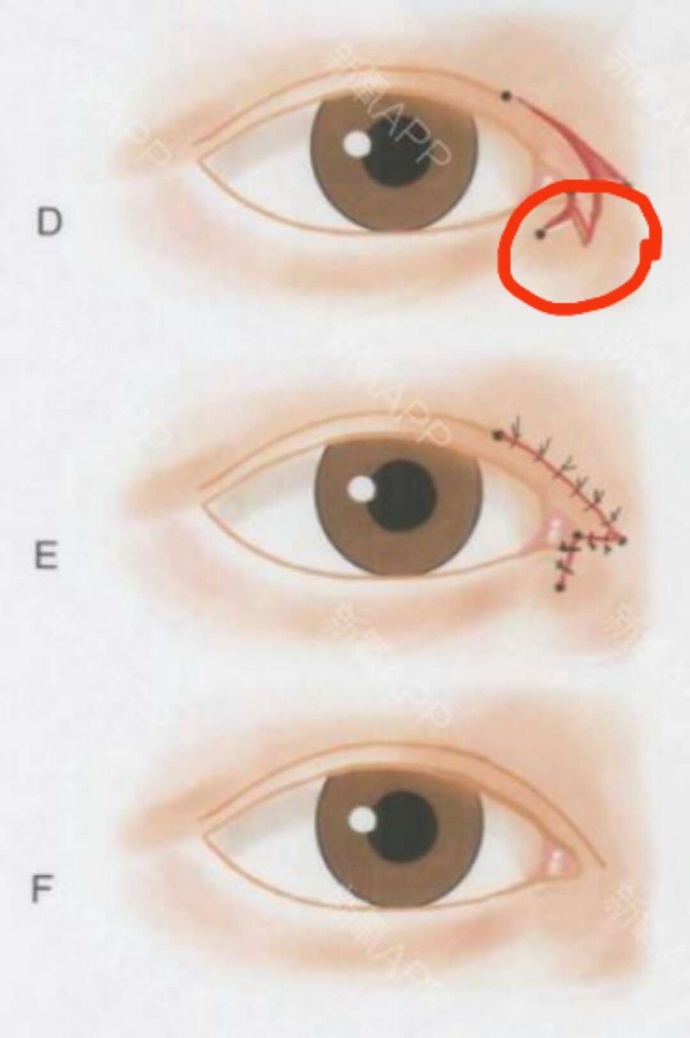 做过埋线还能做双眼皮切开手术吗,陈小剑做双眼皮案例