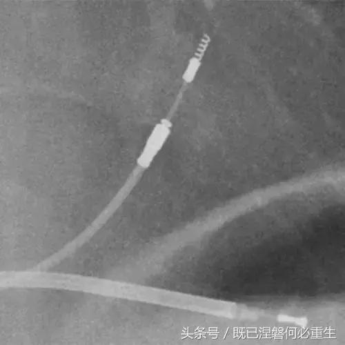 心内除颤仪和起搏器有什么区别,起搏器除颤仪