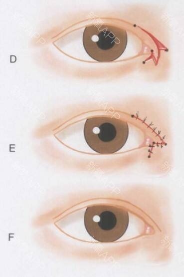 做过埋线还能做双眼皮切开手术吗,陈小剑做双眼皮案例