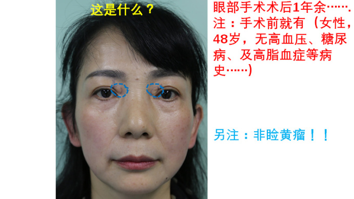 做过埋线还能做双眼皮切开手术吗,陈小剑做双眼皮案例