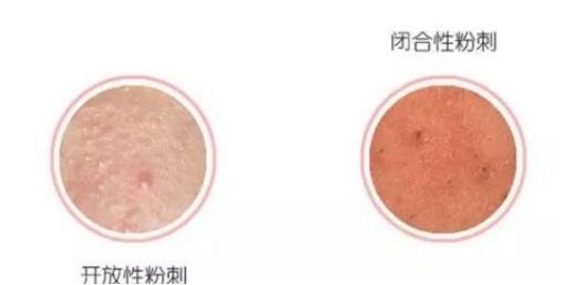 去除痘痘黑头粉刺的药膏,淡化痘印和黑头粉刺药膏