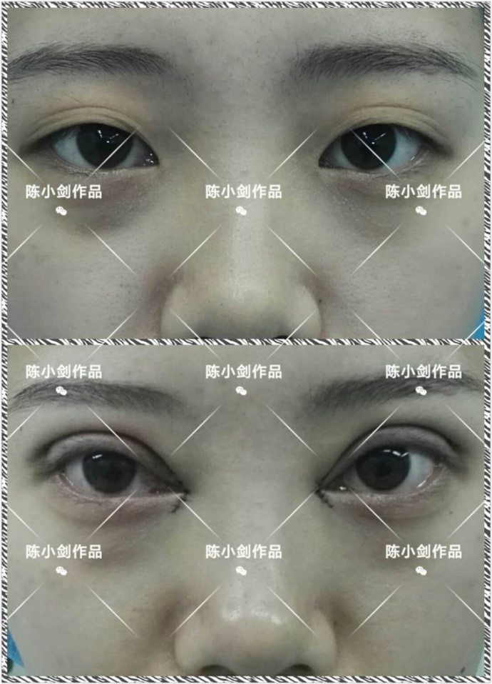 做过埋线还能做双眼皮切开手术吗,陈小剑做双眼皮案例