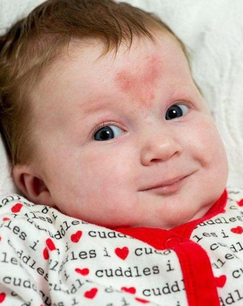 女孩子后背有胎记意义是什么,胎记的意义