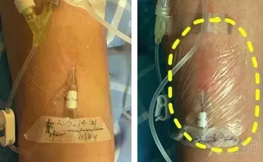 留置针断裂如何发现,留置针断裂入血管的处理方法