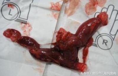 25岁孕妈顺产40天后，莫名垂下“一坨肉”，医生检查后告知来晚了